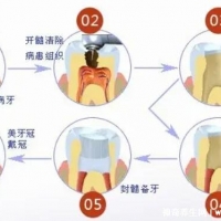 根管治疗后悔一辈子，杀死牙神经令人痛不欲生